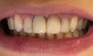 Antes - Linha Média Desviada